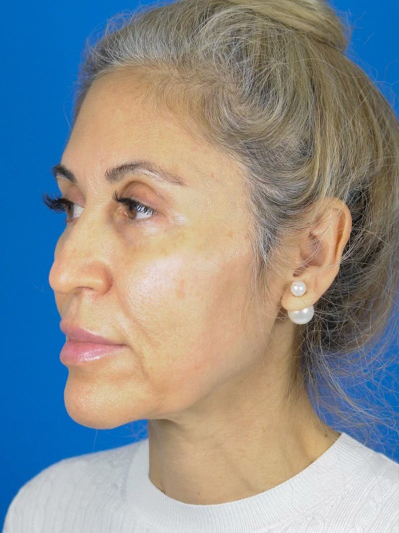 Rhinoplasty Before & After Gallery - Patient 180862778 - Image 5