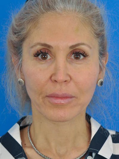 Facelift Before & After Gallery - Patient 180862777 - Image 2