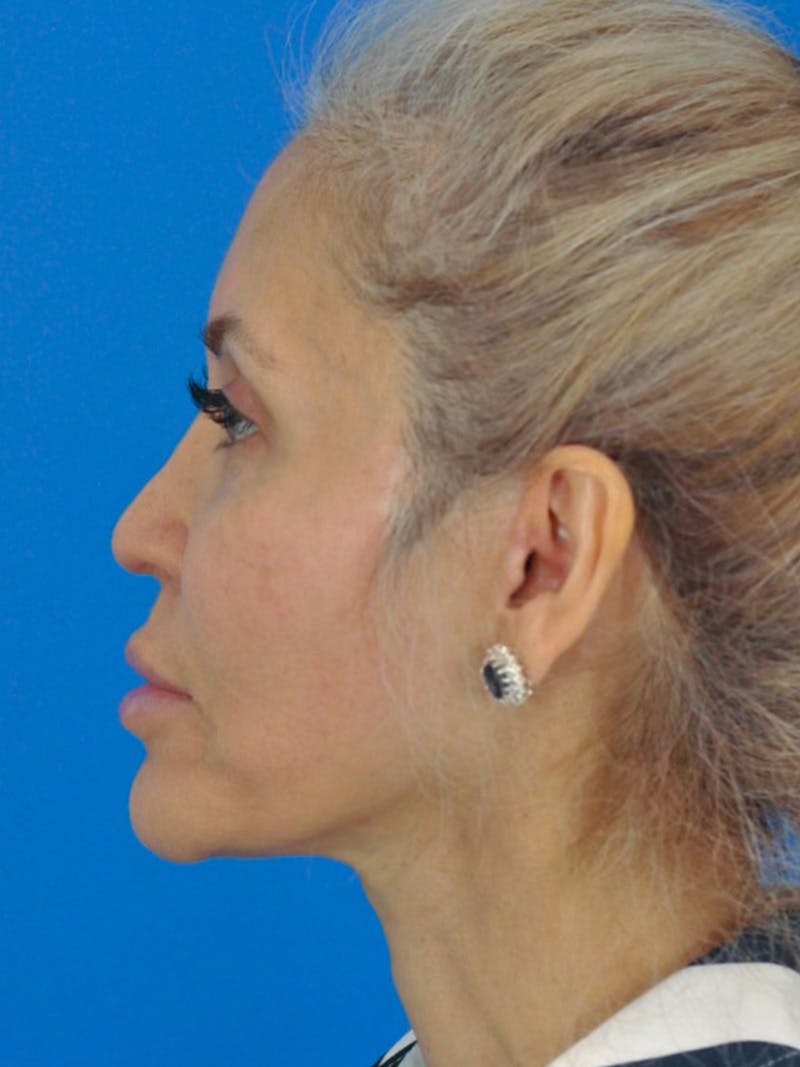 Rhinoplasty Before & After Gallery - Patient 180862778 - Image 2