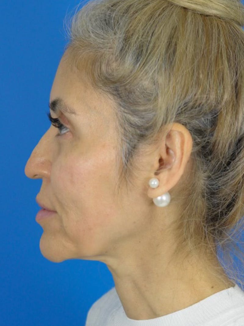 Rhinoplasty Before & After Gallery - Patient 180862778 - Image 1