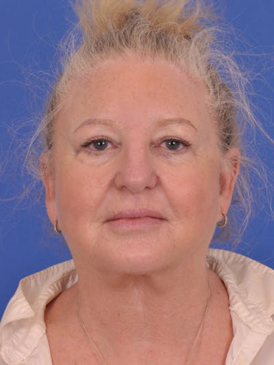 Facelift Before & After Gallery - Patient 180863107 - Image 1