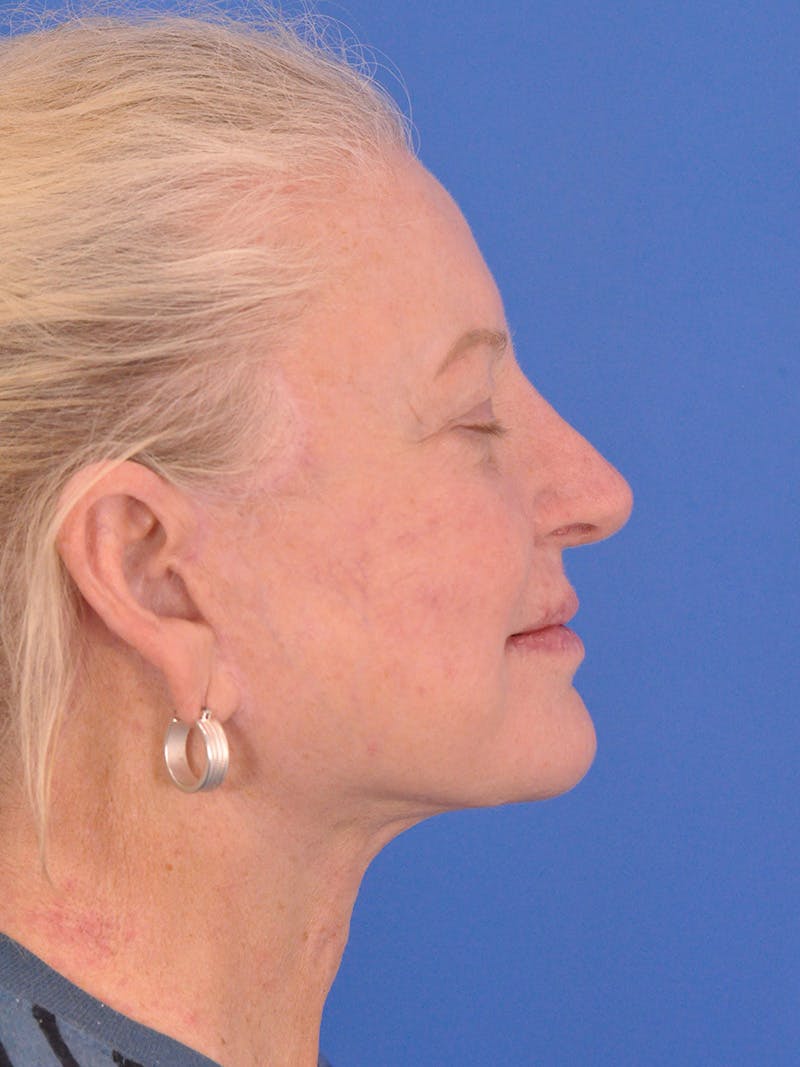 Facelift Before & After Gallery - Patient 180863107 - Image 6