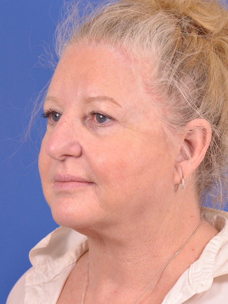 Facelift Before & After Gallery - Patient 180863107 - Image 7