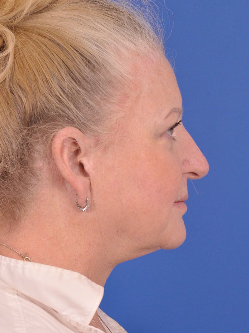 Rhinoplasty Before & After Gallery - Patient 180863044 - Image 1