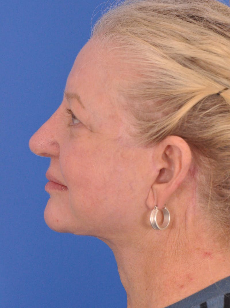 Facelift Before & After Gallery - Patient 180863107 - Image 10
