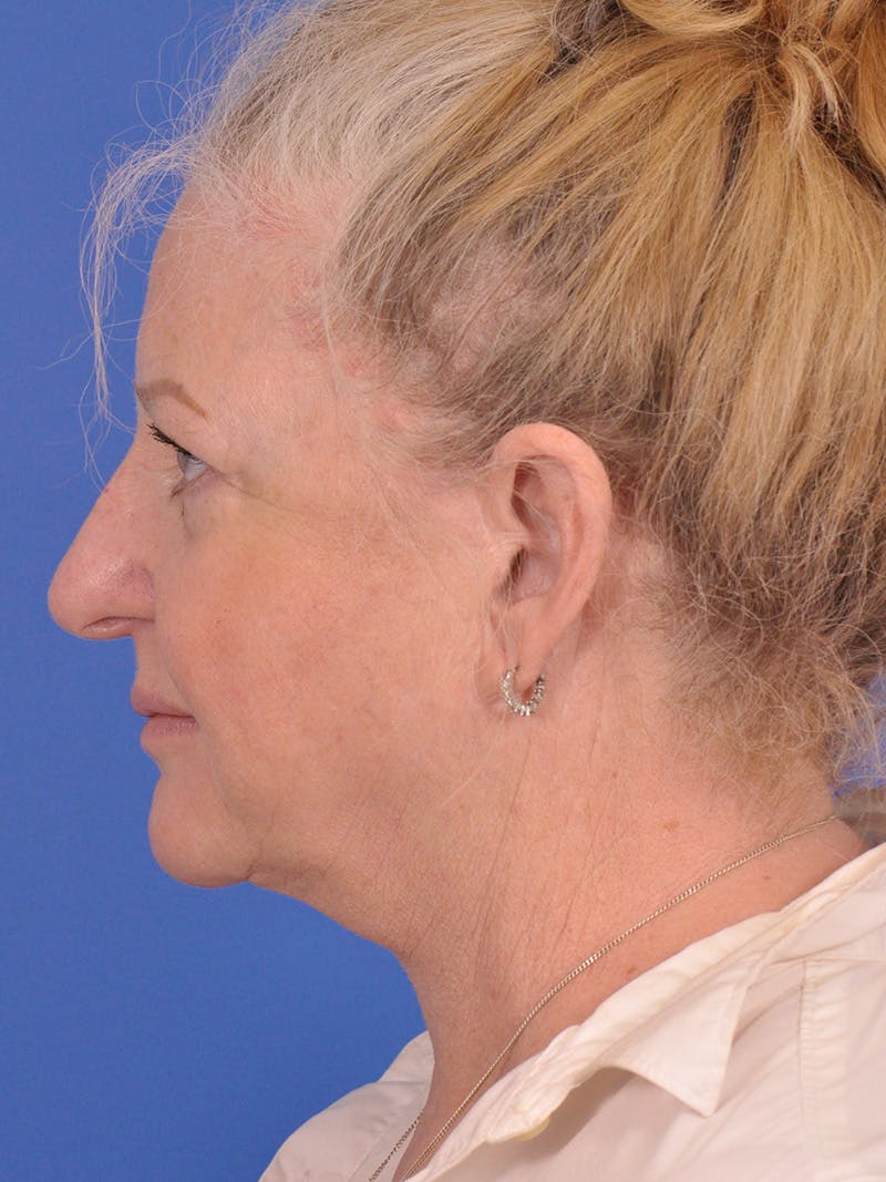 Facelift Before & After Gallery - Patient 180863107 - Image 9