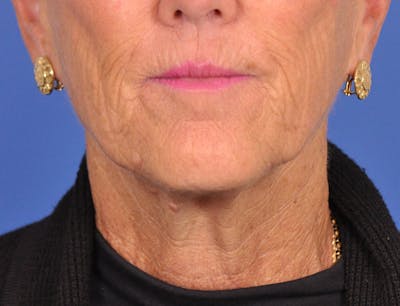 Facelift Before & After Gallery - Patient 180863247 - Image 1