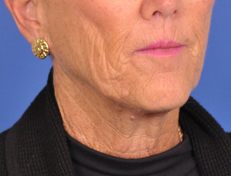 Facelift Before & After Gallery - Patient 180863247 - Image 3