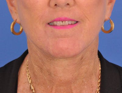 Facelift Before & After Gallery - Patient 180863247 - Image 2