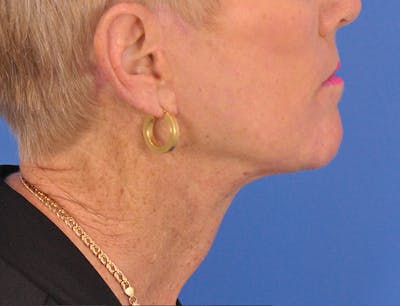 Neck Lift Before & After Gallery - Patient 180863249 - Image 2