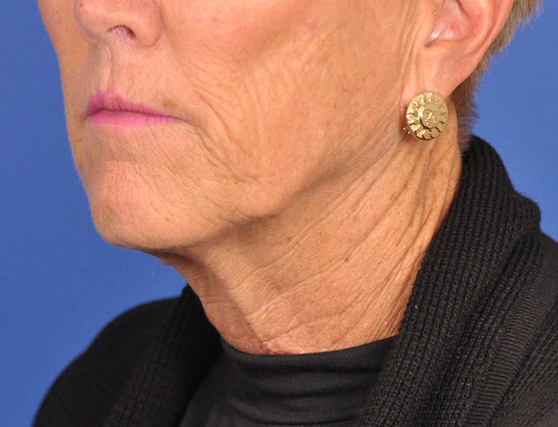 Neck Lift Before & After Gallery - Patient 180863249 - Image 7