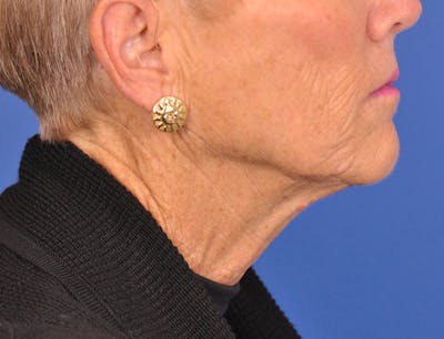 Neck Lift Before & After Gallery - Patient 180863249 - Image 1