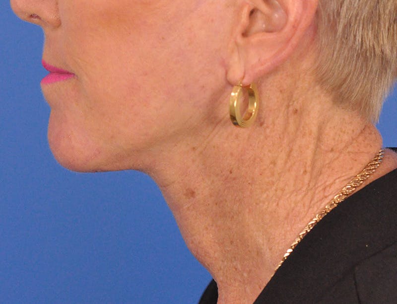 Facelift Before & After Gallery - Patient 180863247 - Image 10