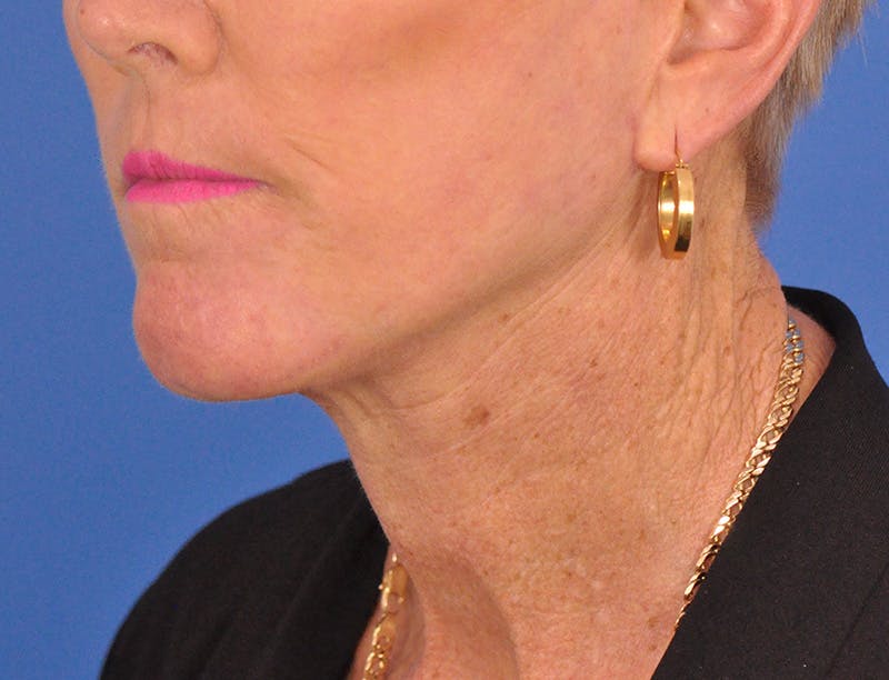 Neck Lift Before & After Gallery - Patient 180863249 - Image 8