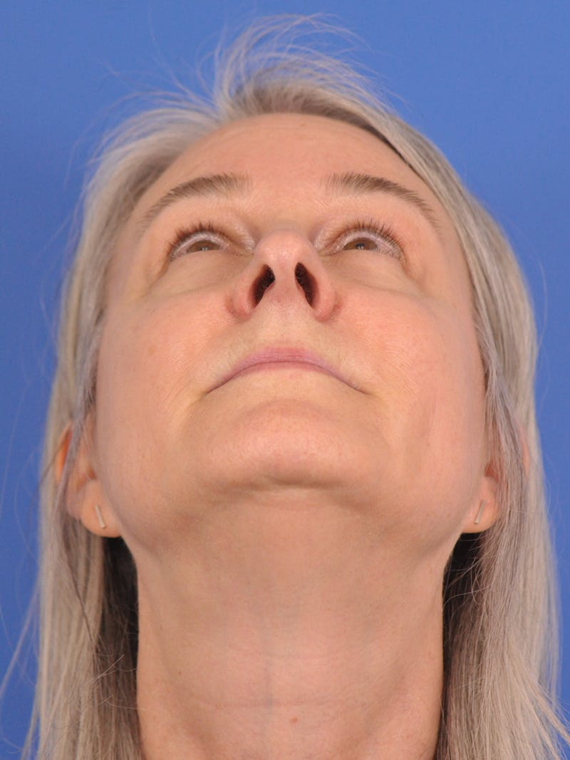 CO2RE Laser Before & After Gallery - Patient 166375724 - Image 1