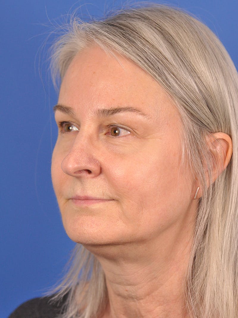 CO2RE Laser Before & After Gallery - Patient 166375724 - Image 3
