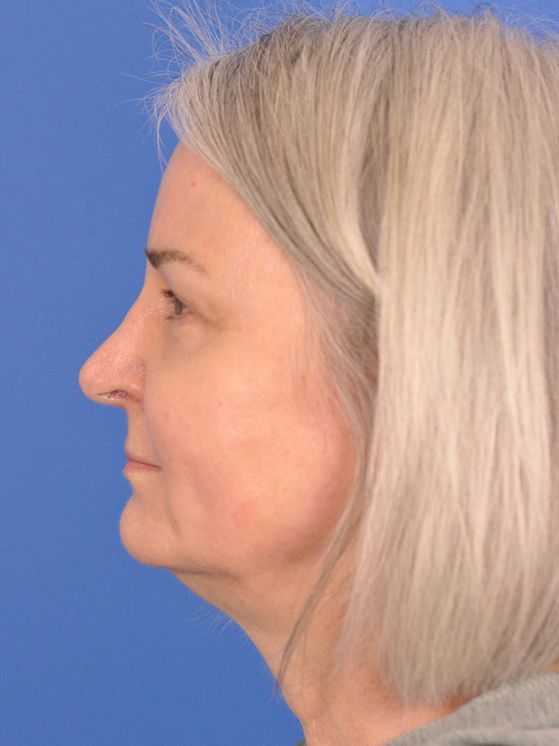 CO2RE Laser Before & After Gallery - Patient 166375724 - Image 6