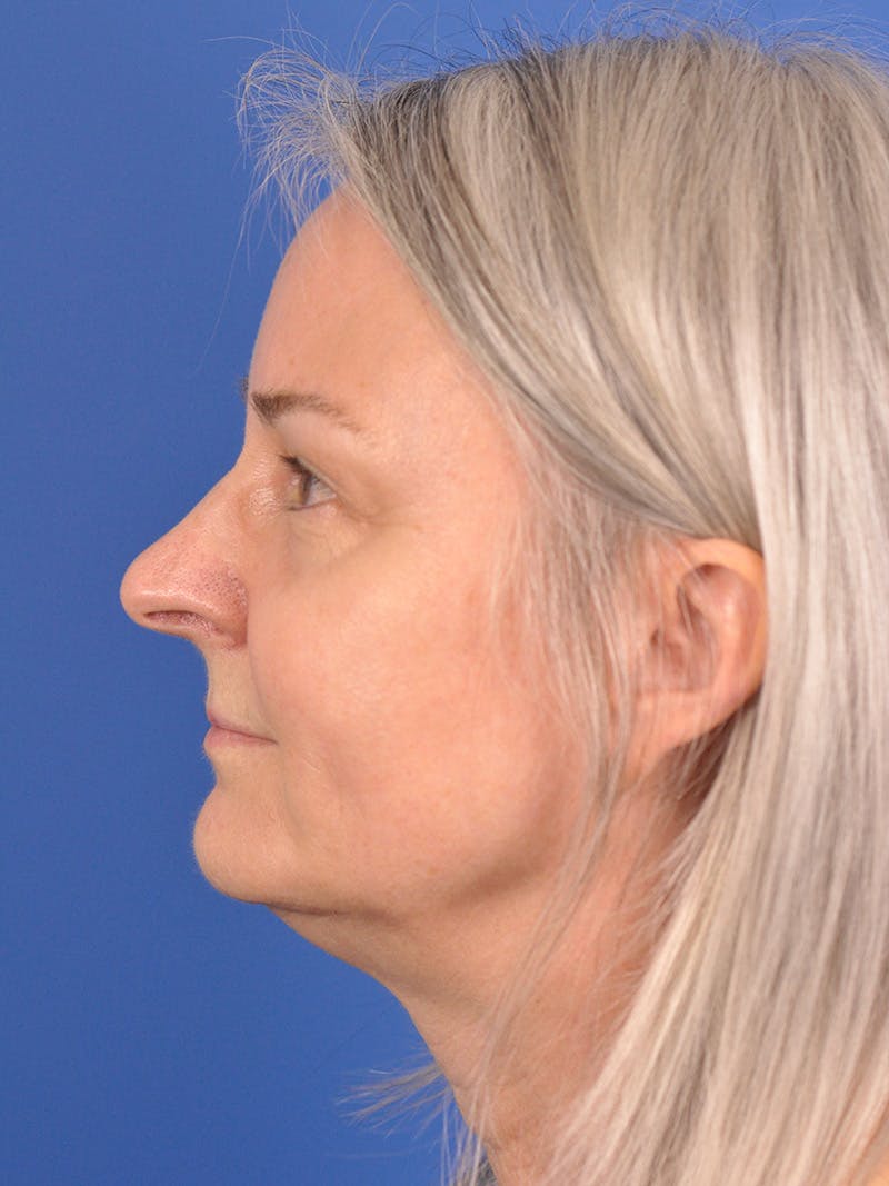 CO2RE Laser Before & After Gallery - Patient 166375724 - Image 5