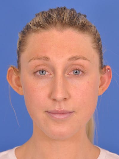 Otoplasty Before & After Gallery - Patient 180863296 - Image 1