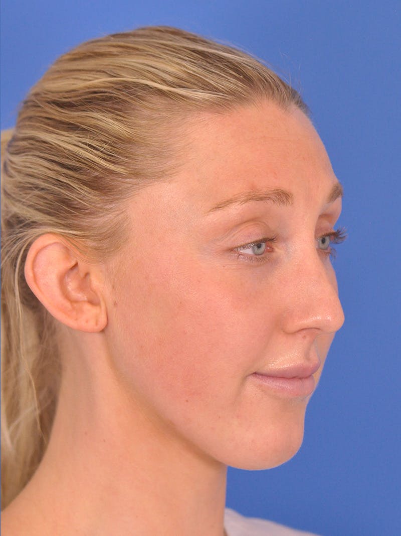 Otoplasty Before & After Gallery - Patient 180863296 - Image 7