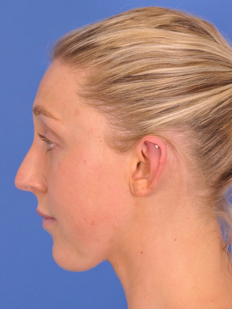 Otoplasty Before & After Gallery - Patient 180863296 - Image 5
