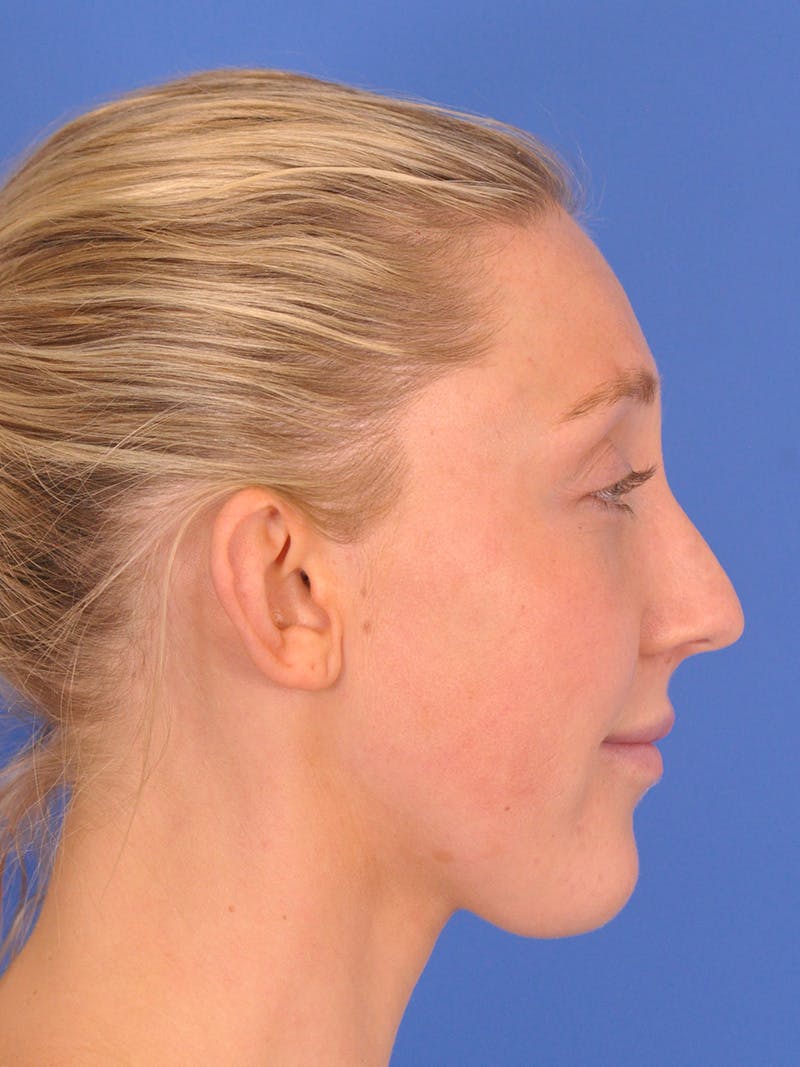Otoplasty Before & After Gallery - Patient 180863296 - Image 9