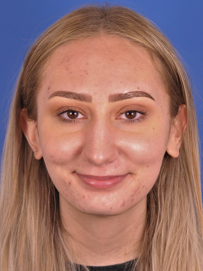 Rhinoplasty Before & After Gallery - Patient 163837811 - Image 1