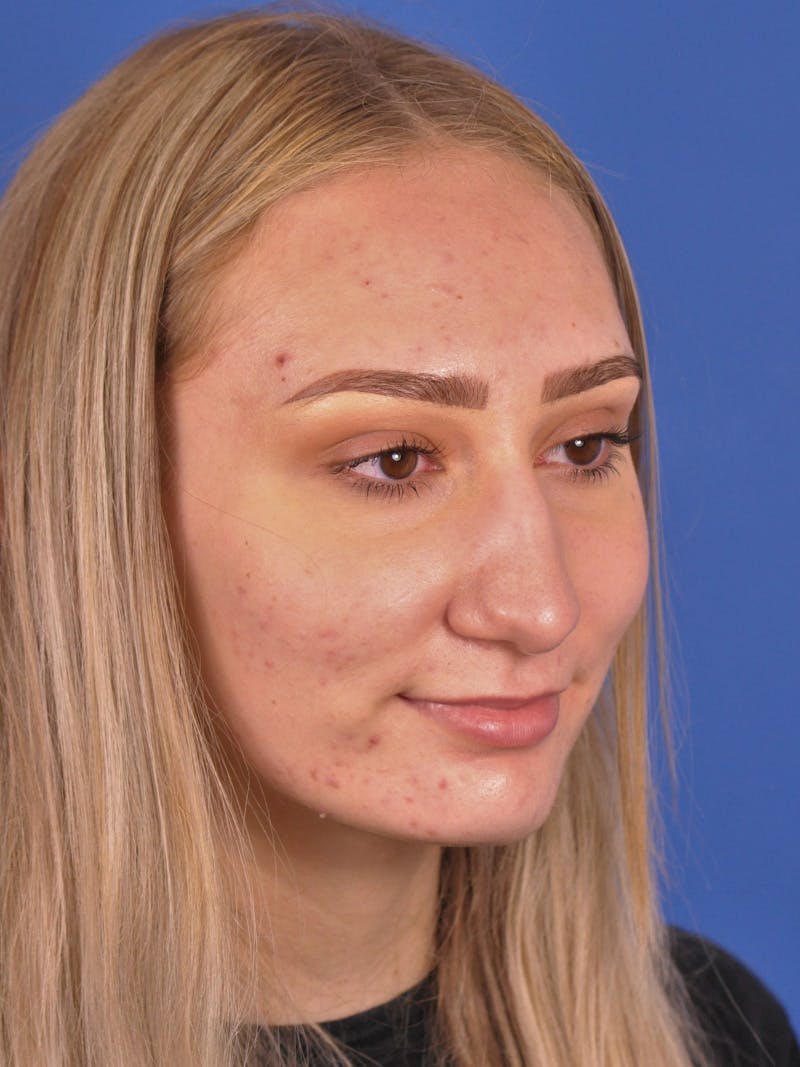 Rhinoplasty Before & After Gallery - Patient 163837811 - Image 3