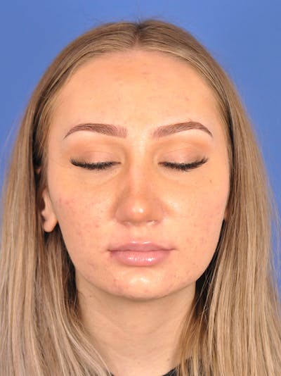 Rhinoplasty Before & After Gallery - Patient 163837811 - Image 2