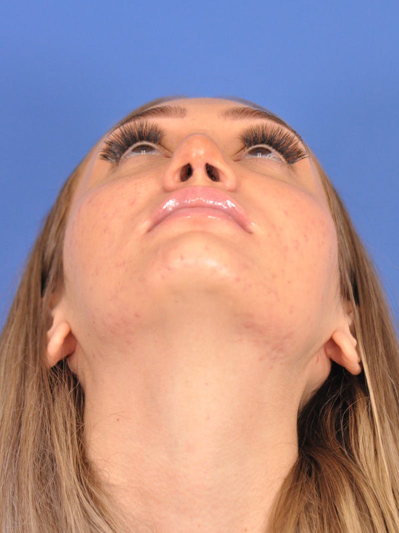 Rhinoplasty Before & After Gallery - Patient 163837811 - Image 12