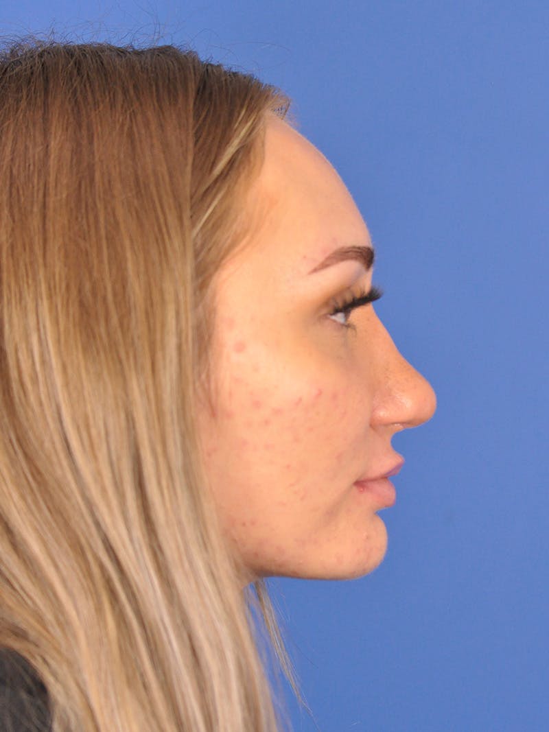 Rhinoplasty Before & After Gallery - Patient 163837811 - Image 6