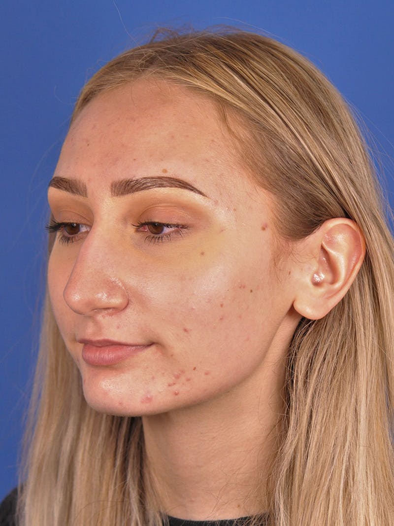 Rhinoplasty Before & After Gallery - Patient 163837811 - Image 7