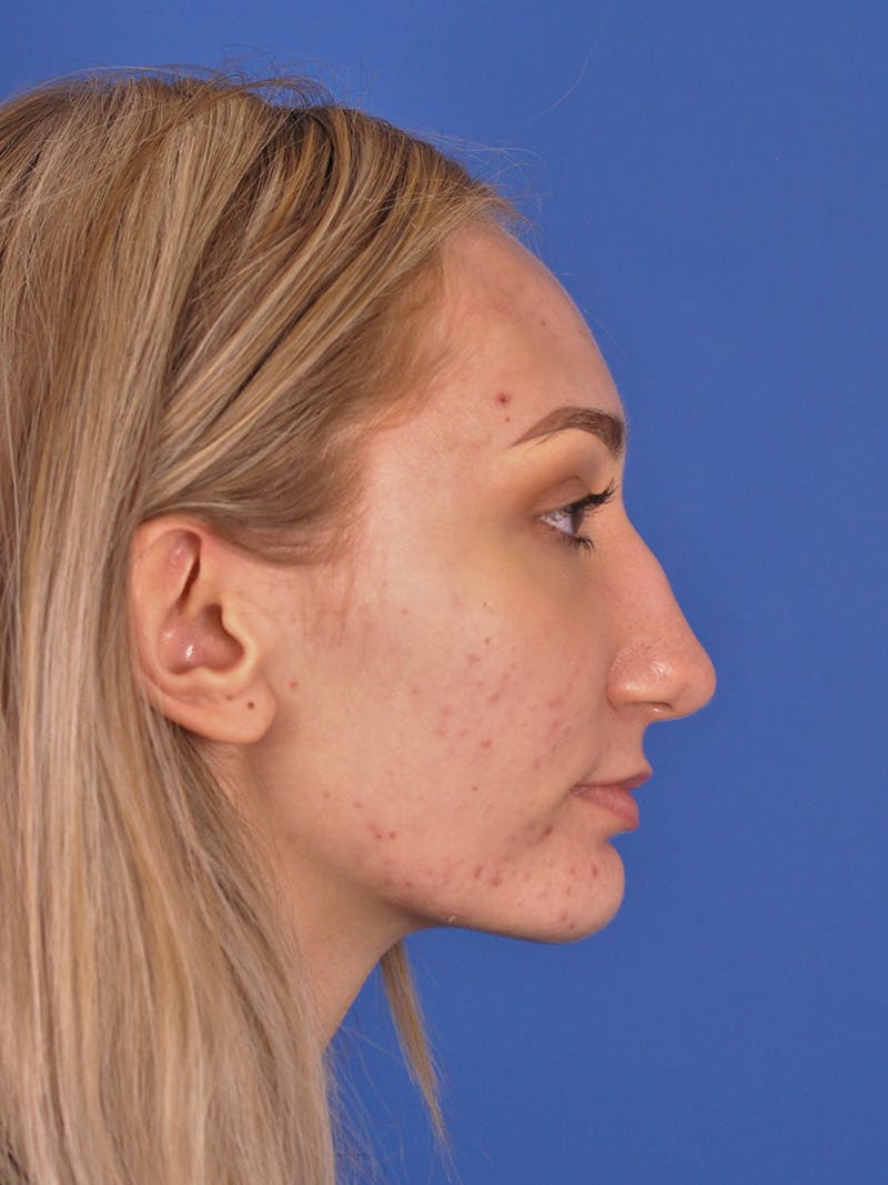 Rhinoplasty Before & After Gallery - Patient 163837811 - Image 5