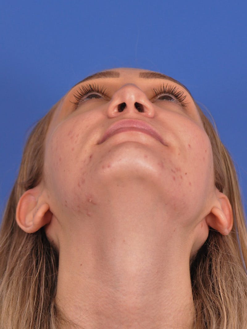 Rhinoplasty Before & After Gallery - Patient 163837811 - Image 11