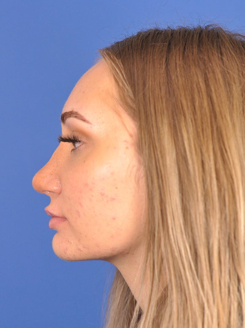 Rhinoplasty Before & After Gallery - Patient 163837811 - Image 10