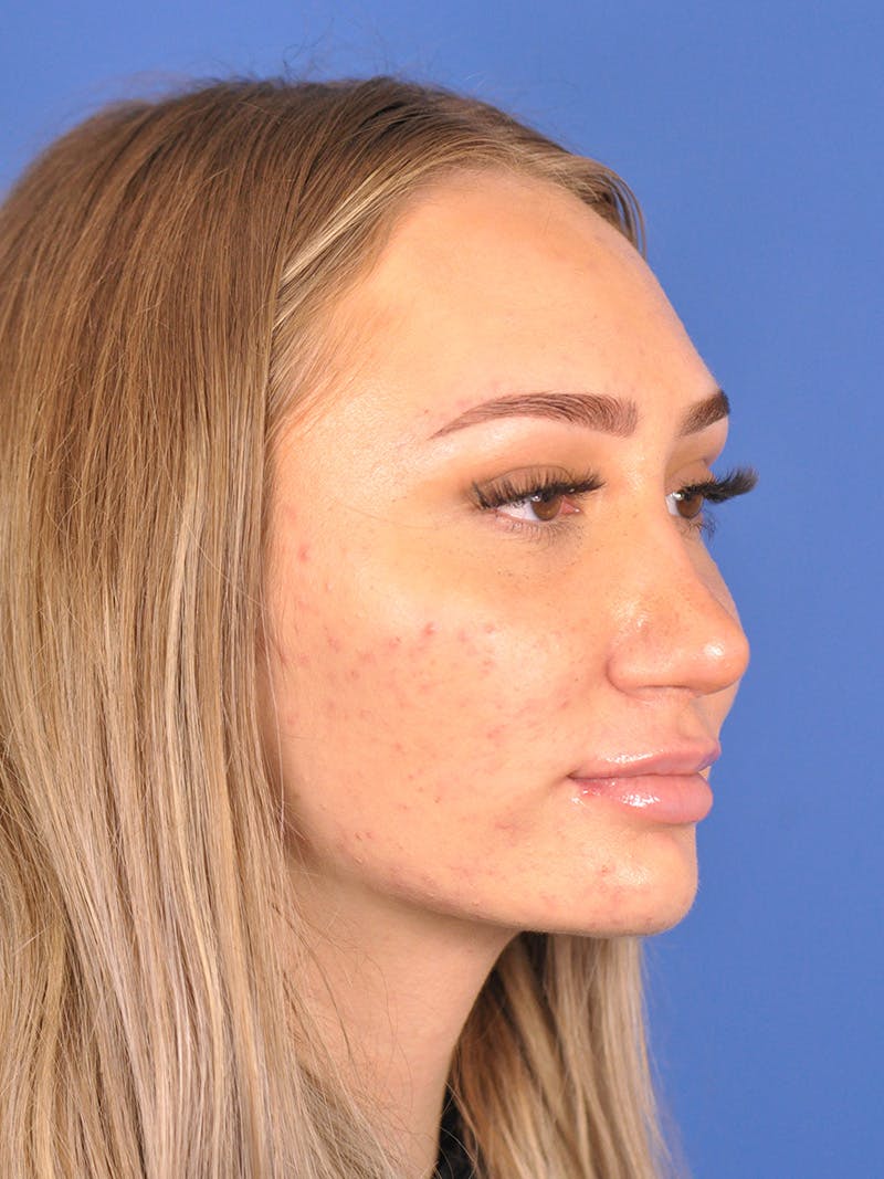 Rhinoplasty Before & After Gallery - Patient 163837811 - Image 4