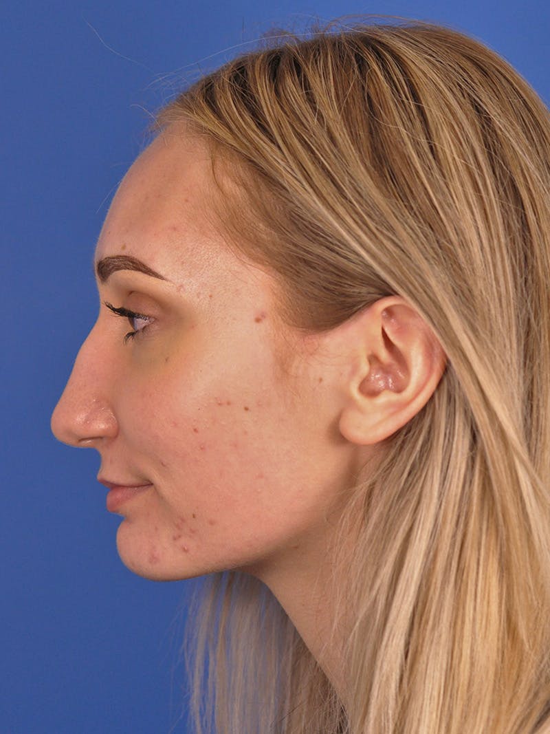 Rhinoplasty Before & After Gallery - Patient 163837811 - Image 9
