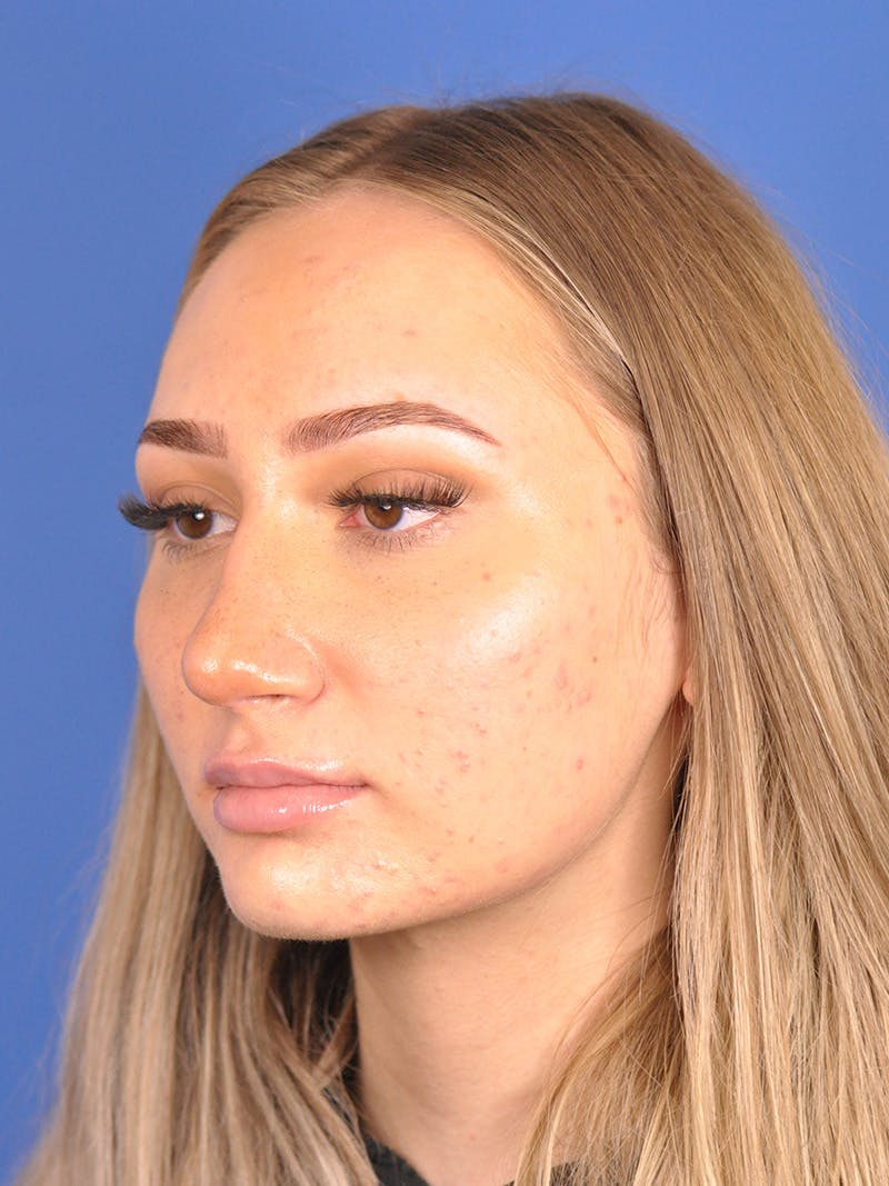 Rhinoplasty Before & After Gallery - Patient 163837811 - Image 8