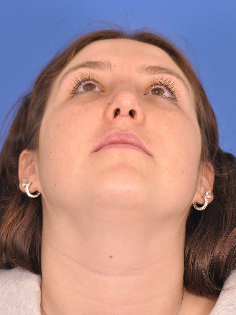 Rhinoplasty Before & After Gallery - Patient 180863337 - Image 12