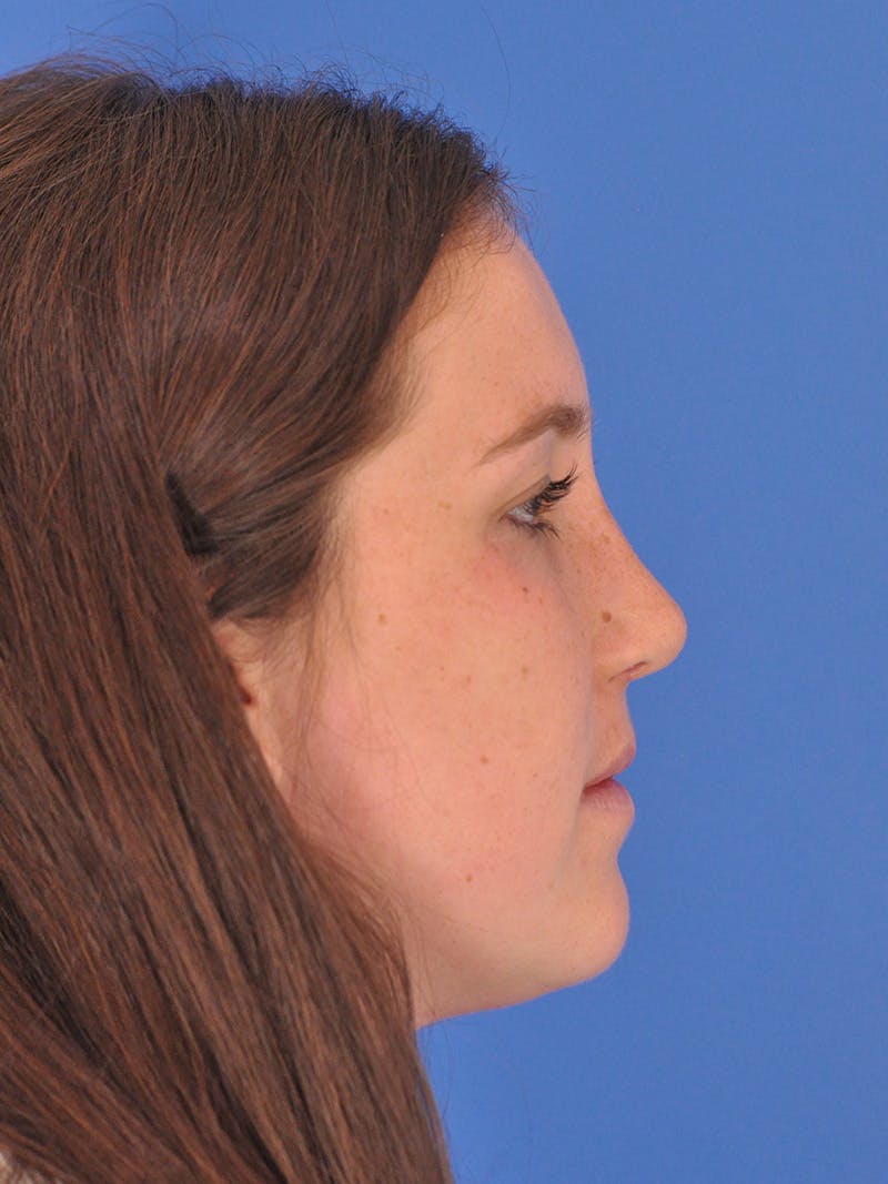 Rhinoplasty Before & After Gallery - Patient 180863337 - Image 2