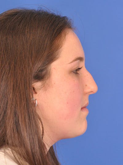 Rhinoplasty Before & After Gallery - Patient 180863337 - Image 1