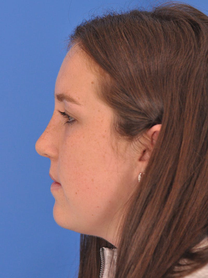 Rhinoplasty Before & After Gallery - Patient 180863337 - Image 10