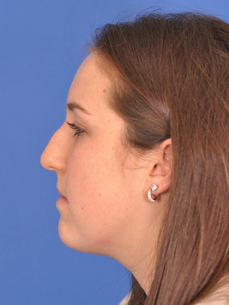 Rhinoplasty Before & After Gallery - Patient 180863337 - Image 9