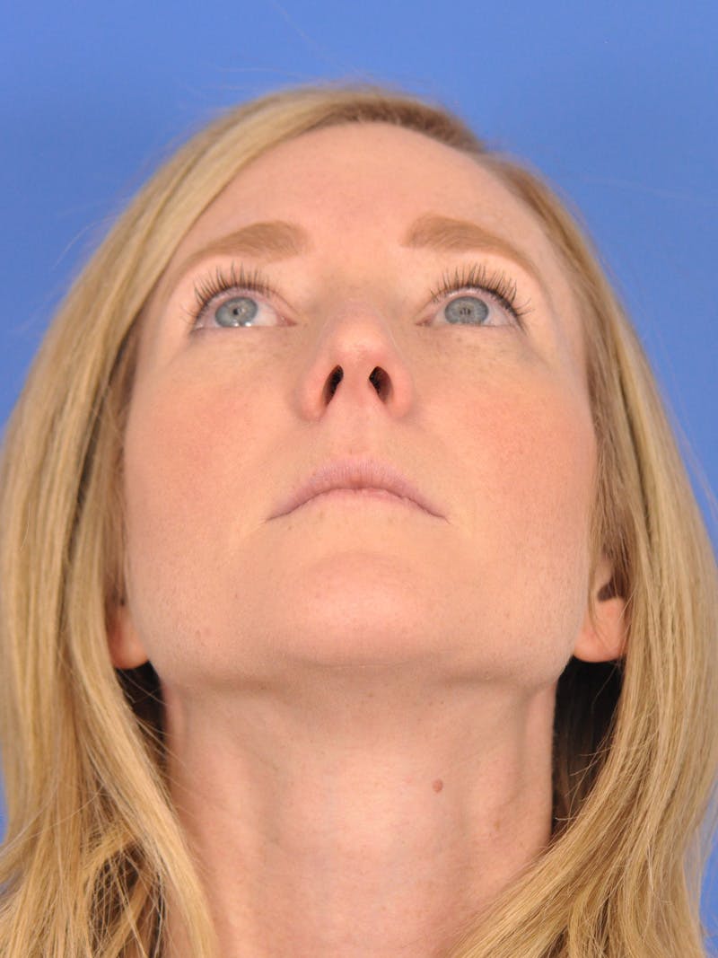 Rhinoplasty Before & After Gallery - Patient 180863382 - Image 11
