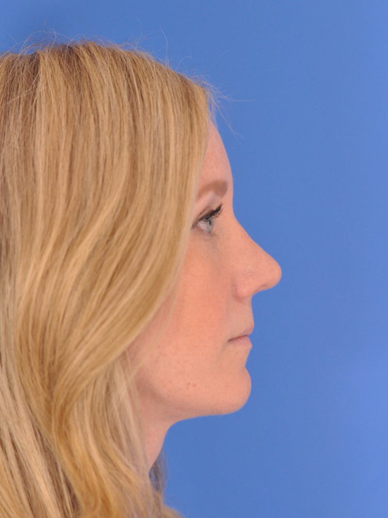 Rhinoplasty Before & After Gallery - Patient 180863382 - Image 2