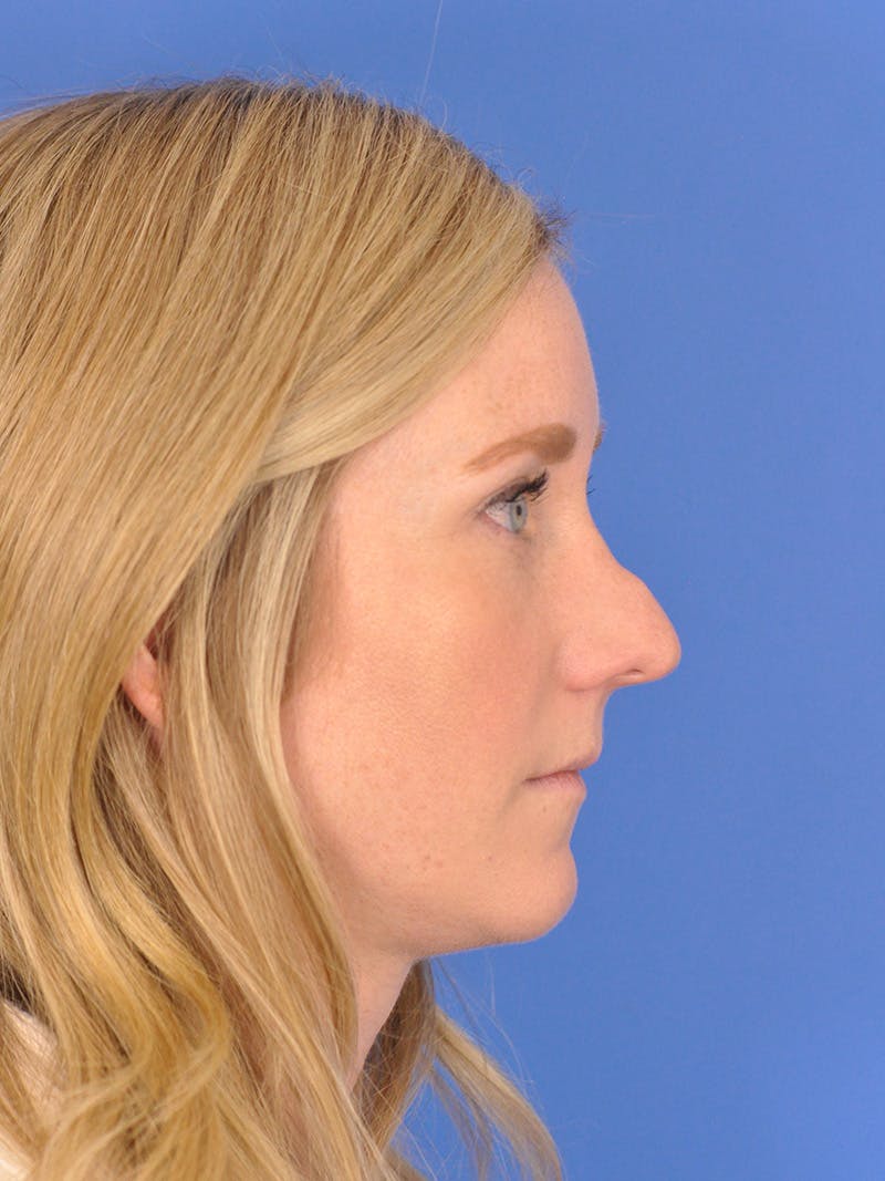 Rhinoplasty Before & After Gallery - Patient 180863382 - Image 1
