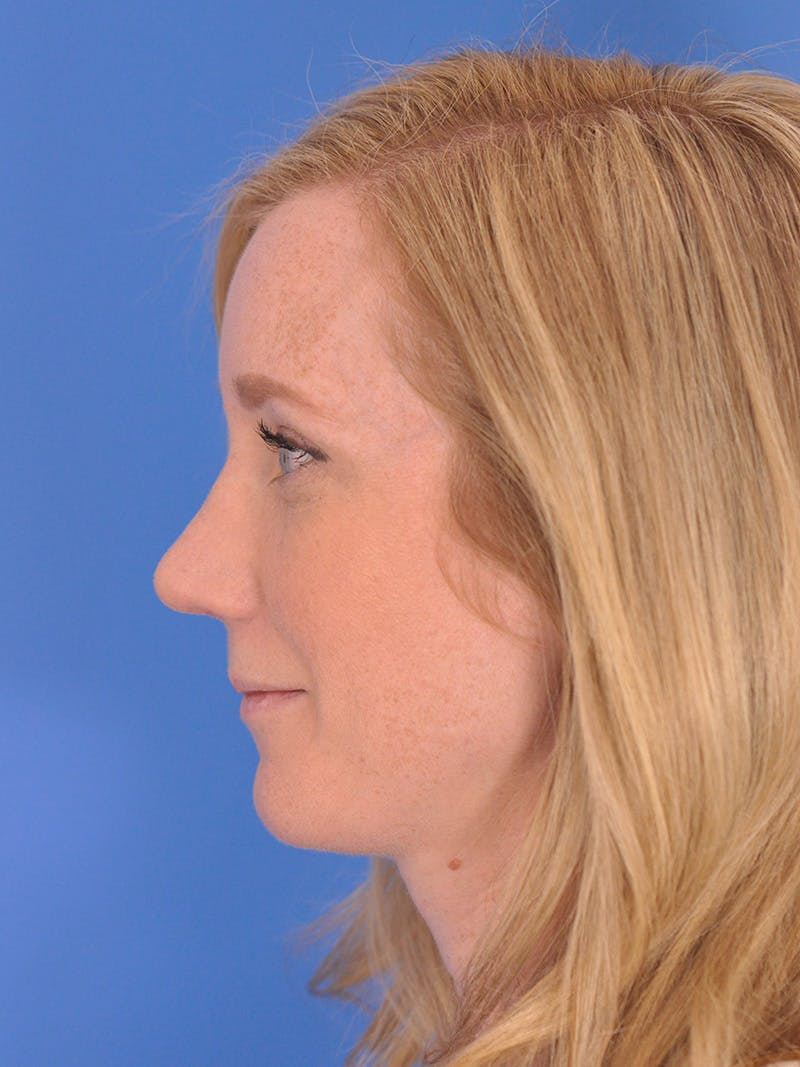 Rhinoplasty Before & After Gallery - Patient 180863382 - Image 10