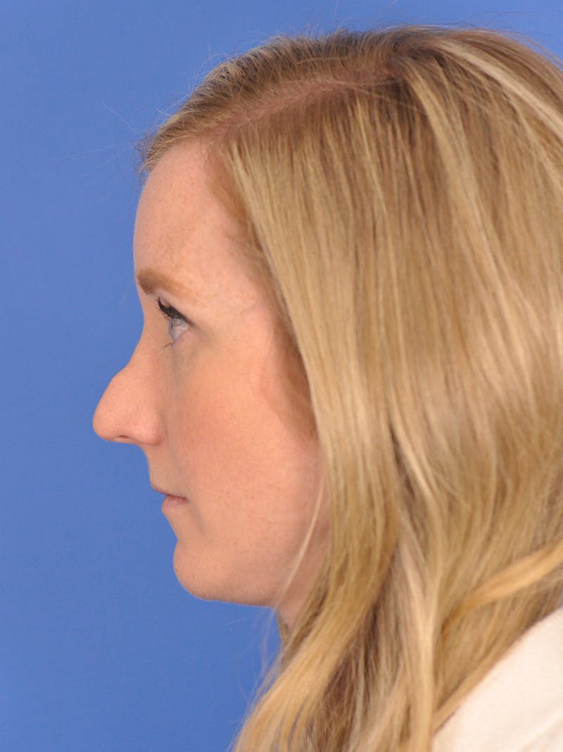 Rhinoplasty Before & After Gallery - Patient 180863382 - Image 9