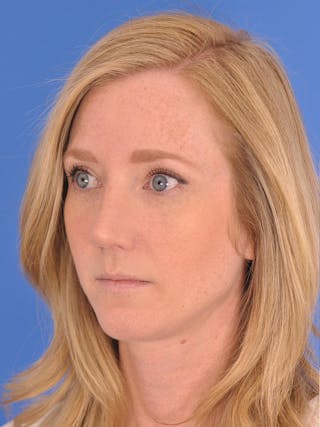 Rhinoplasty Before & After Gallery - Patient 180863382 - Image 8
