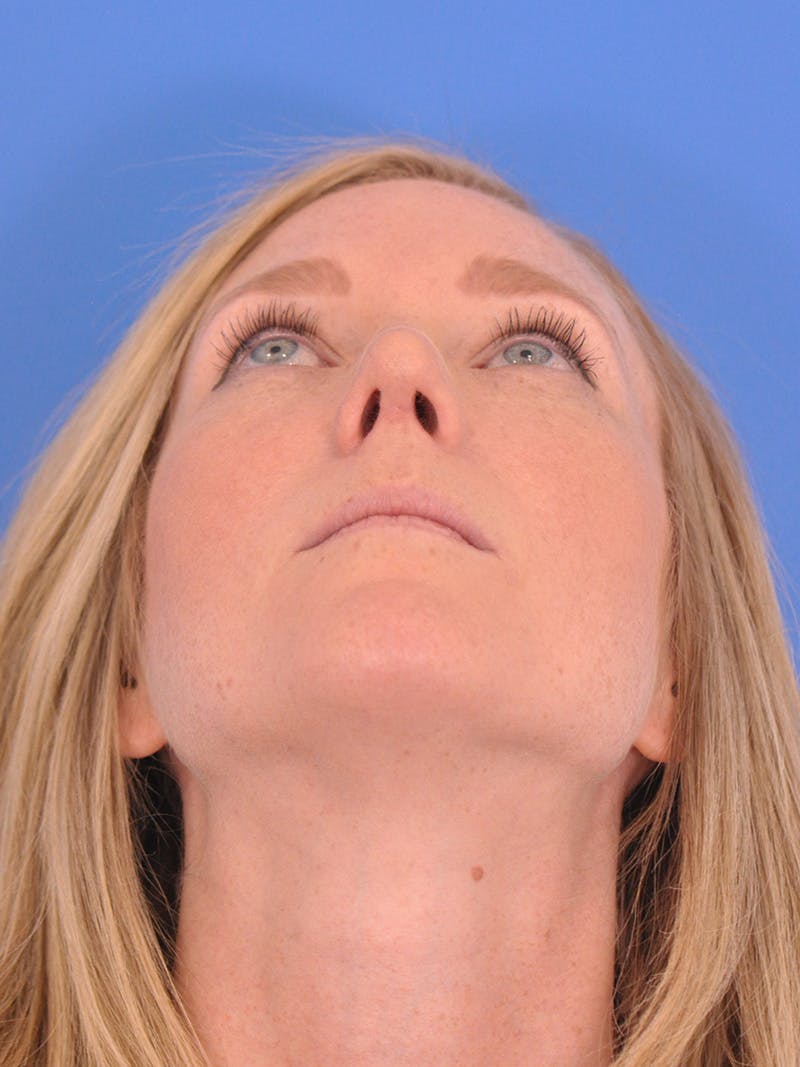 Rhinoplasty Before & After Gallery - Patient 180863382 - Image 12